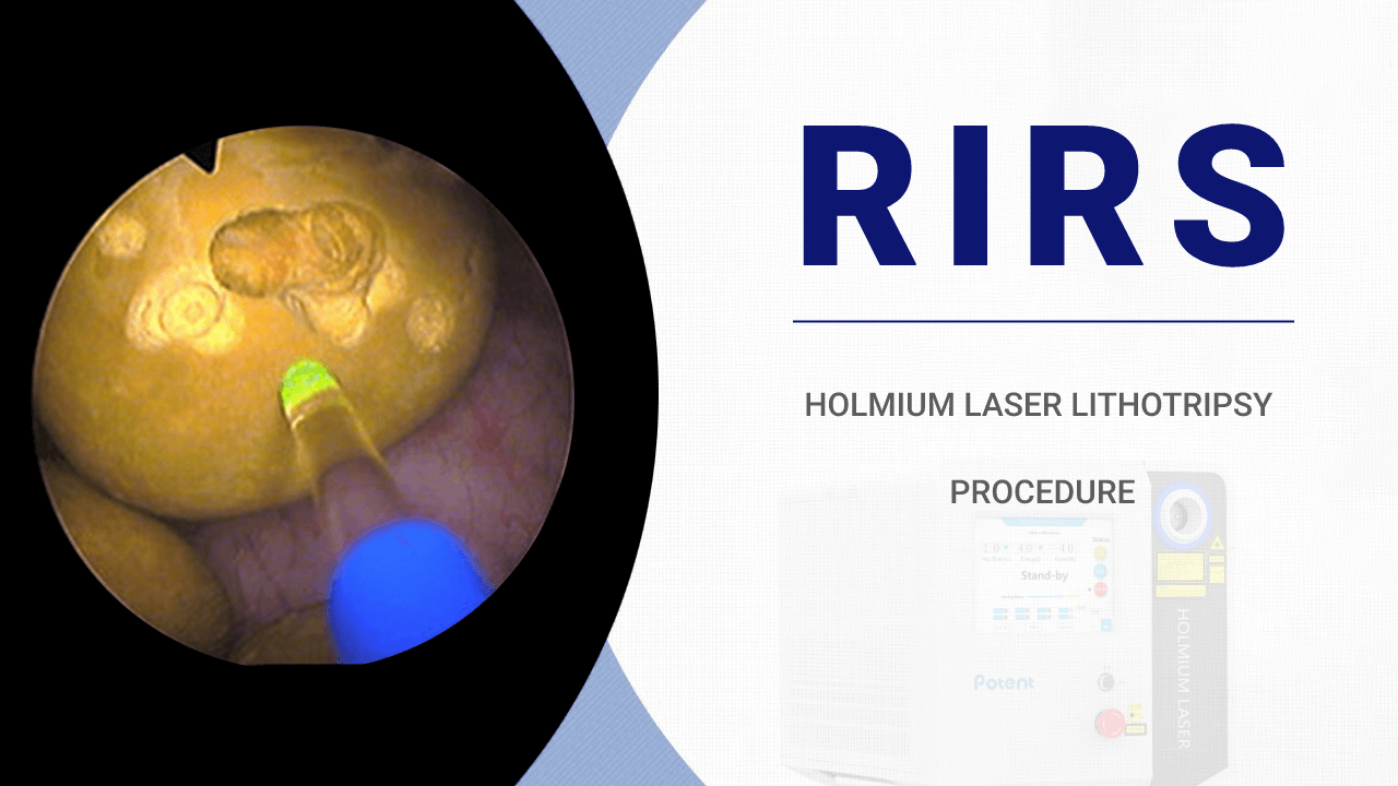 Holmium Laser Lithotripsy Procedure
