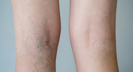 Laser spider vein removal aftercare